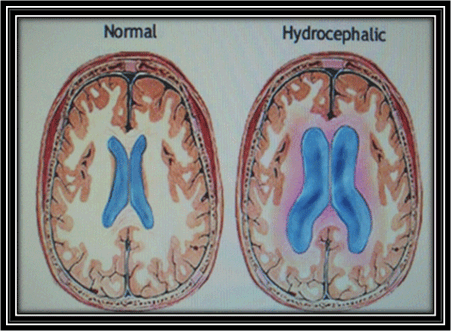hidrocefalia [Neurocirugía Contemporánea]