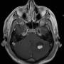hemangioblastomai7426.jpg