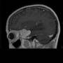 meningiomaalaesfenoidalrm.jpg