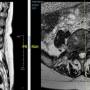 tumorespinalvertebrallumbari7352.jpg